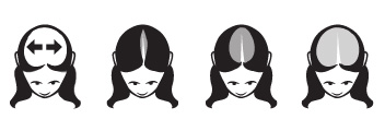 slide_femalepatternhairloss