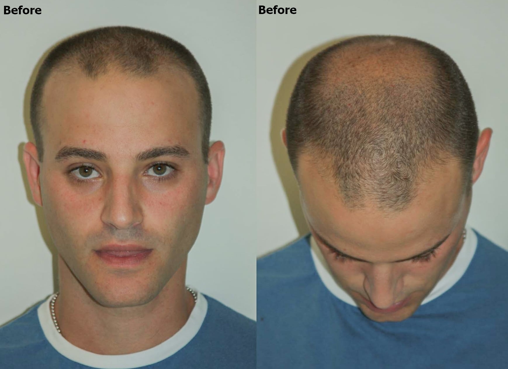 Hairline And Crown Hair Restoration Alviarmani Hair Transplant Los