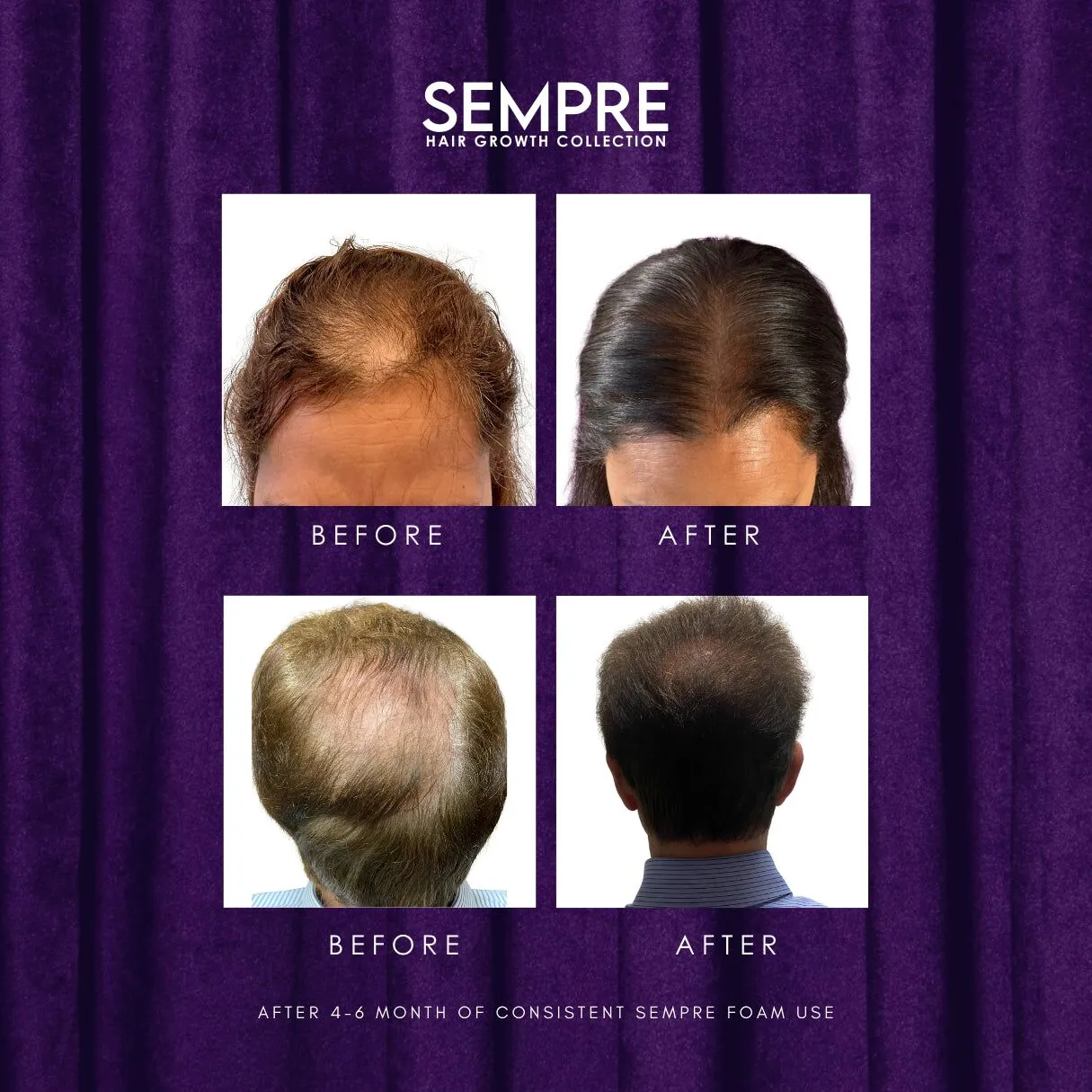 Sempre Natural DHT Blockers