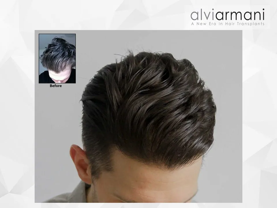 FUE High Density
