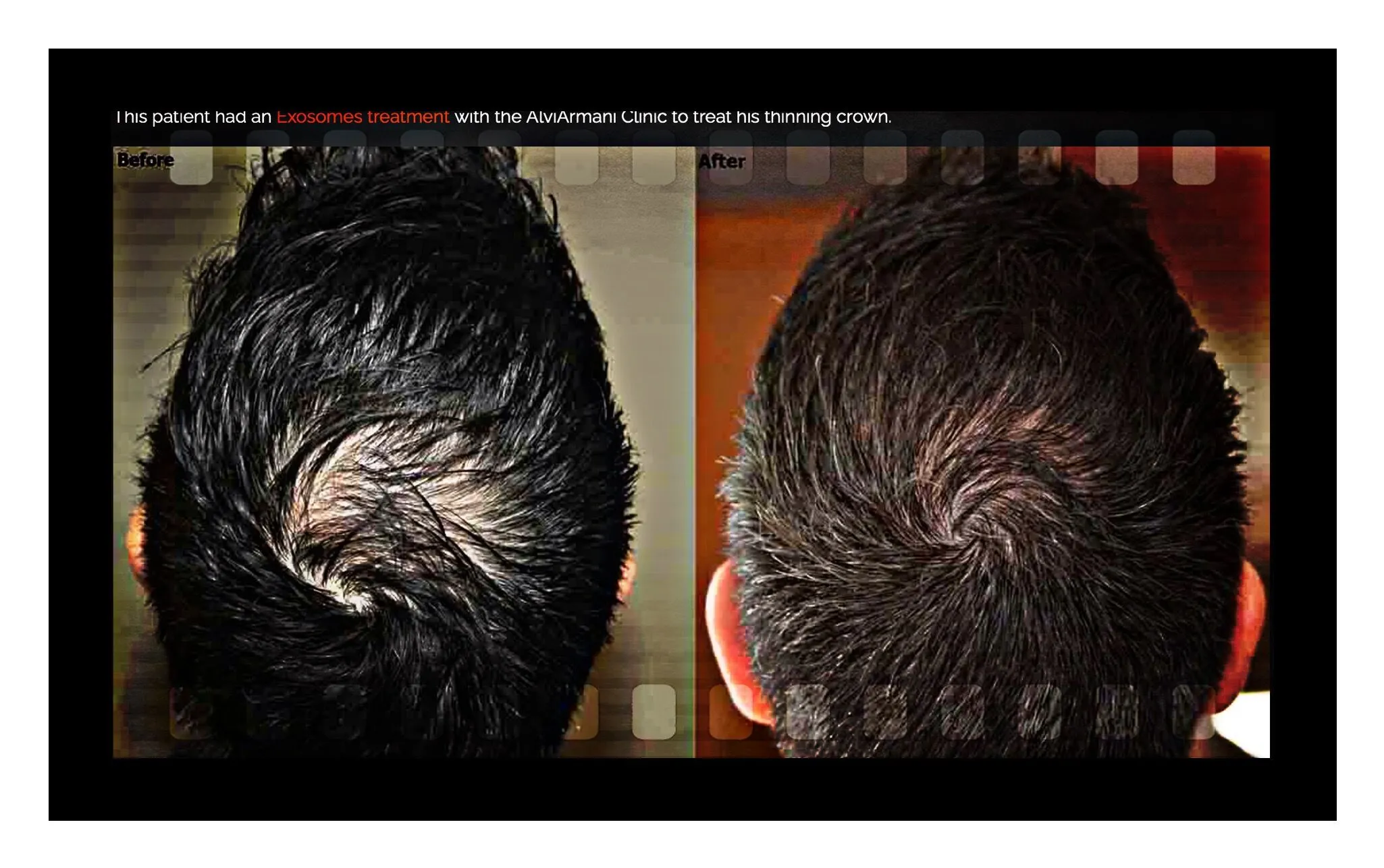 Exosome Hair Restoration Before And After