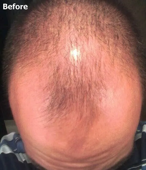 Before FUE transplant