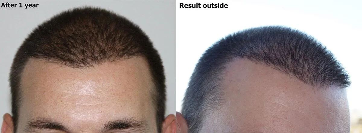 One year after FUE transplant