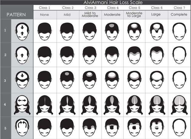 Hair Loss Chart Norwood