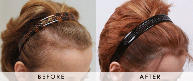 Does Hair Transplant Work For Female Pattern Baldness on Women Guides