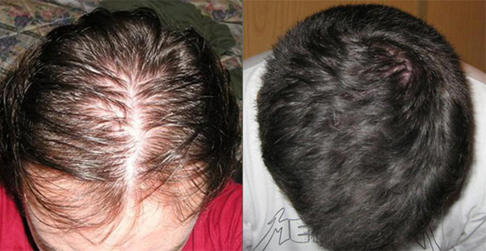 Hair Treatment Patient 33