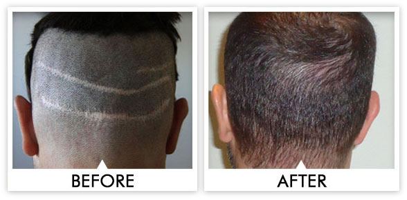Strip Scar Repair - AlviArmani - Hair Transplant Los Angeles