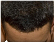 hair-transplant-patient-46