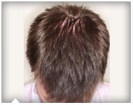 hair-transplant-patient-56