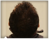 hair-transplant-patient-61