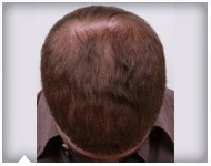 hair-transplant-patient-66