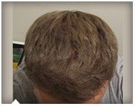hair-transplant-patient-69