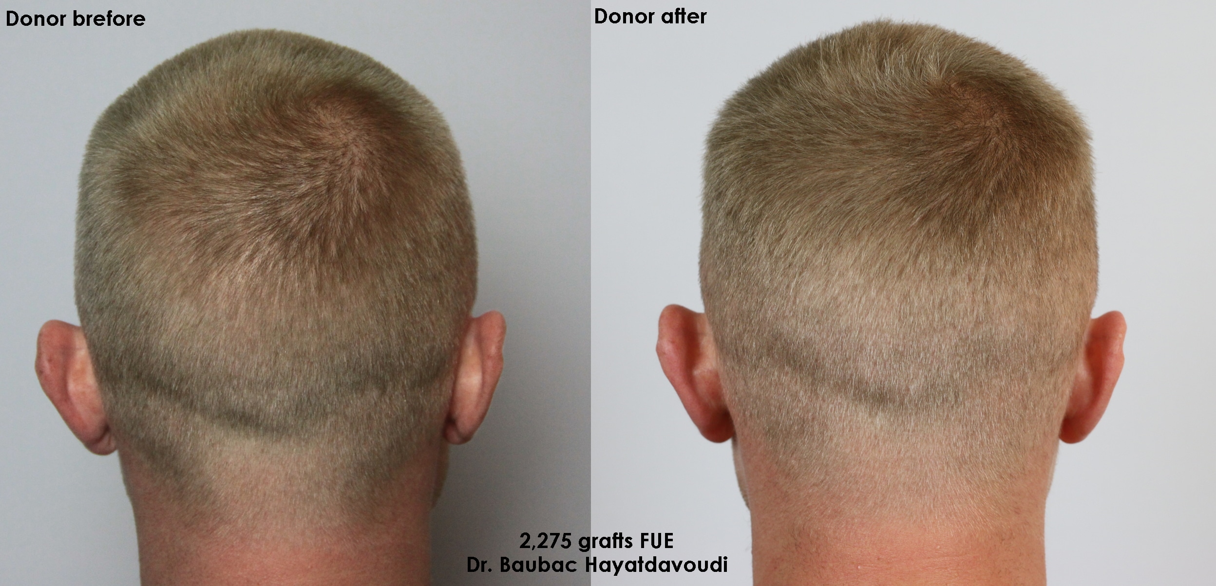Case Study - Can I Wear My Hair Short After A Hair Transplant? - AlviArmani  - Hair Transplant Los Angeles