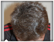 hair-transplant-patient-100