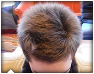 hair-transplant-patient-101