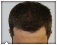 hair-transplant-patient-102