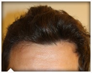 hair-transplant-patient-103