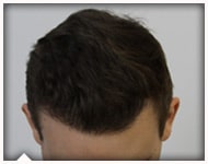 hair-transplant-patient-73