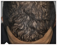 hair-transplant-patient-75