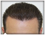 hair-transplant-patient-76