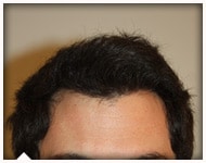 hair-transplant-patient-77