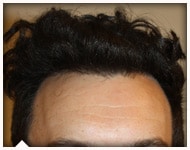 hair-transplant-patient-78