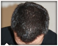 hair-transplant-patient-79