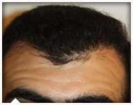 hair-transplant-patient-80