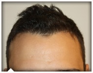 hair-transplant-patient-81