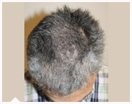hair-transplant-patient-82