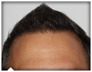 hair-transplant-patient-83