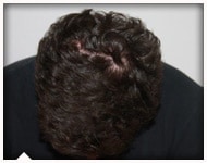 hair-transplant-patient-85