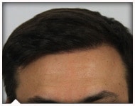 hair-transplant-patient-86