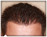 hair-transplant-patient-87