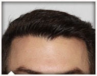 hair-transplant-patient-88