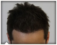 hair-transplant-patient-89