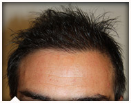 hair-transplant-patient-90