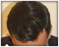 hair-transplant-patient-91