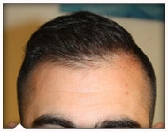 hair-transplant-patient-93