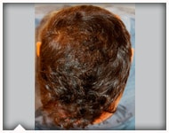 hair-transplant-patient-94