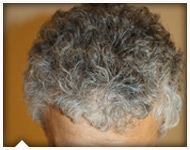 hair-transplant-patient-95