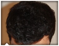 hair-transplant-patient-96
