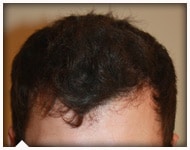 hair-transplant-patient-97