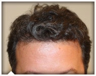 hair-transplant-patient-98