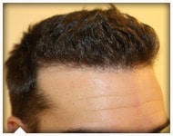hair-transplant-patient-99