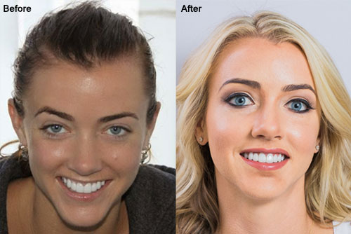 hair-restoration-for-women