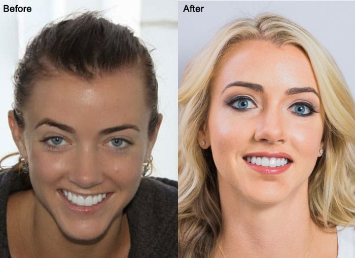 Before and After Female Hair Transplant At AlviArmani Facial Framing
