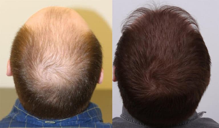 Crown hair transplant design and posterior scalp restoration at AlviArmani