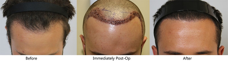 Affordable Hair Transplant in Orlando - Hair Restoration & Replacement FL