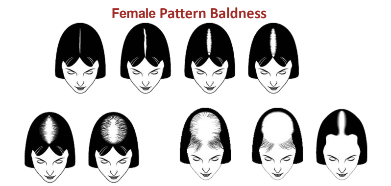 female-pattern-hair-loss